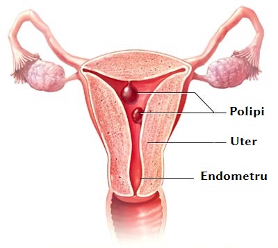 Polyp of the body of the uterus (endometrial polyp)