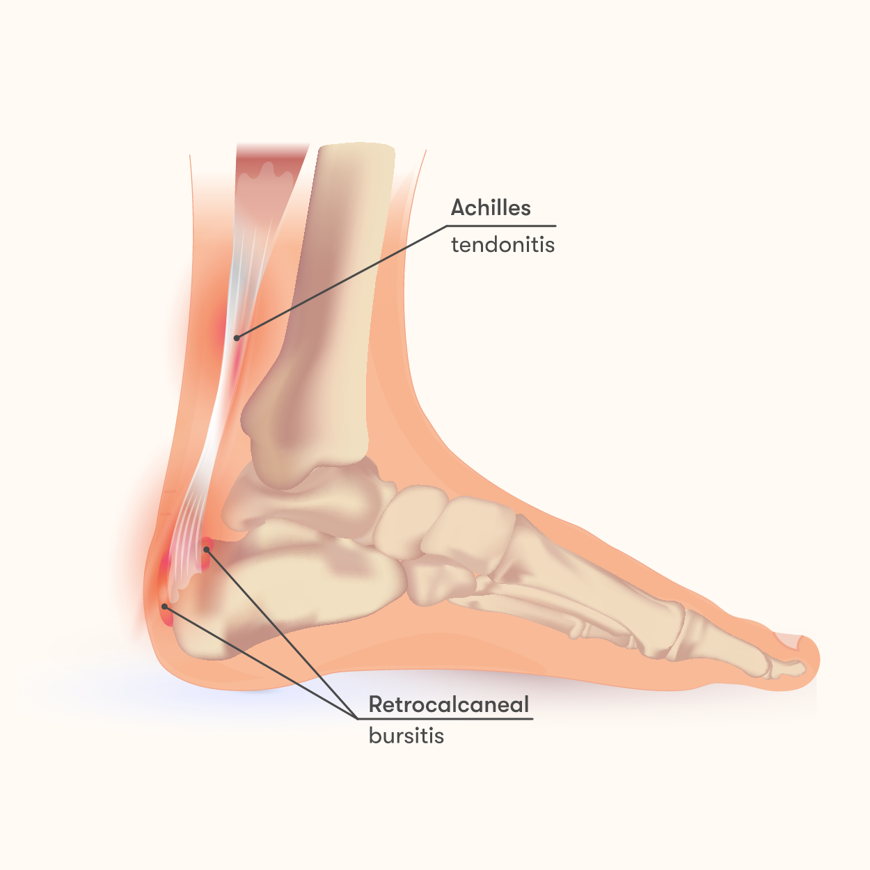 Calcaneal bursitis